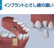 インプラントとさし歯の違い