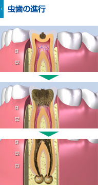 虫歯の進行
