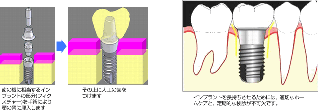 インプラント