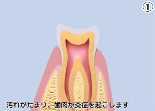 歯周病