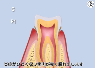 歯周病