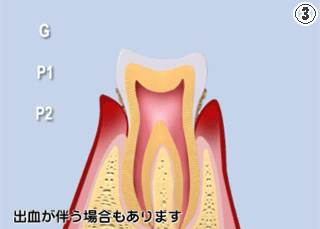 歯周病