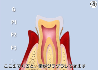 歯周病