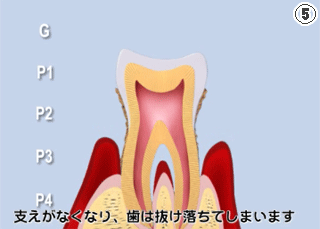 歯周病