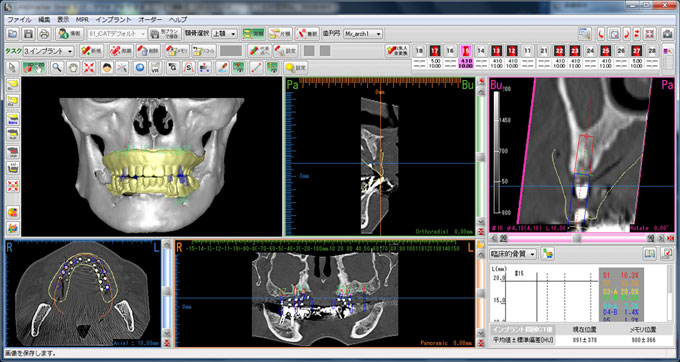 インプラント・ＣＴ診査