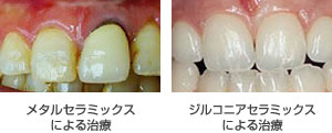 ジルコニア治療